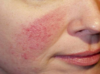 Vein Treatment