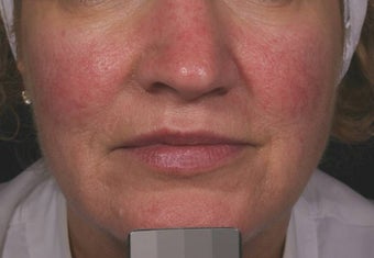 Vein treatment