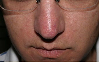 Vein treatment