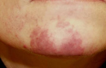 Vascular malformations or birthmarks