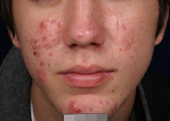 Acne laser treatment with PDT