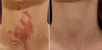 Vbeam for Redness/Bruising Post Accident