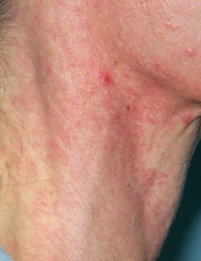 Vbeam laser treatment
