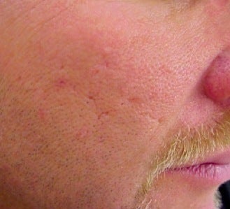 Vbeam treatment for scars
