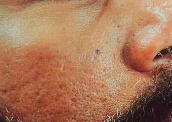 Vbeam for scars