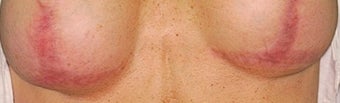 Breast implant scar removal