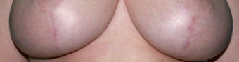 Laser treatment for breast implant scars