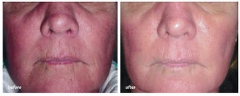 VBeam for rosacea