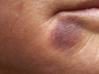 V Beam treatment of a bruise