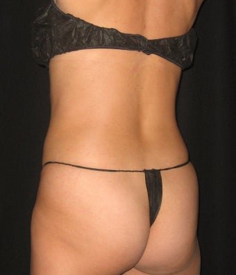 VASER Shape to Love Handles