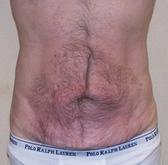 VASER Shape to Abdomen