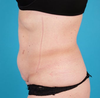 VASER Shape to Abdomen