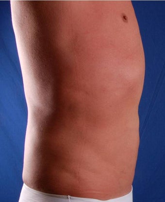 VASER Shape to Abdomen