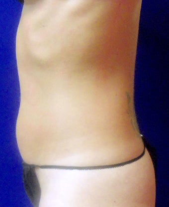 VASER Shape to Abdomen