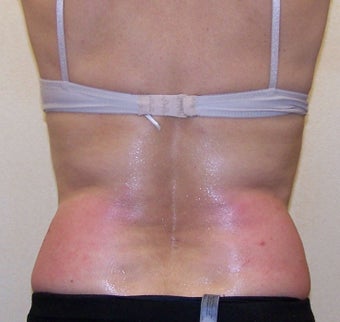 VASER Shape fo Back