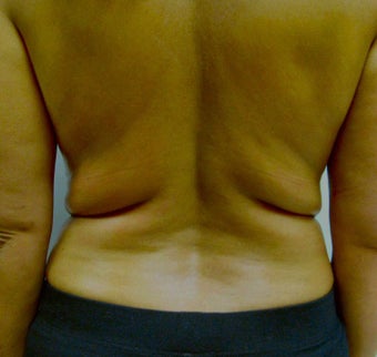VASER Shape to Back