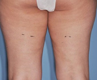 VASER Shape to Legs