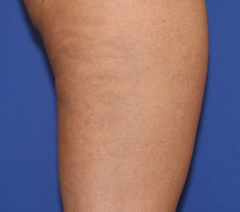 VASER Shape to Legs