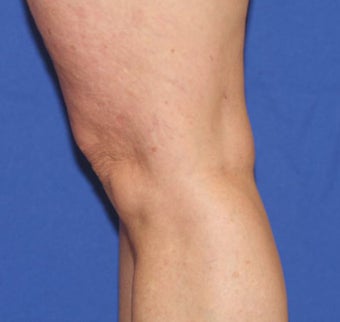 VASER Shape to Legs