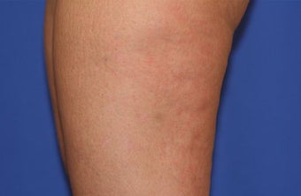 VASER Shape to Legs