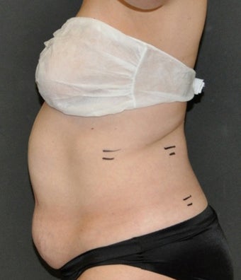 VASER Shape to Abdomen
