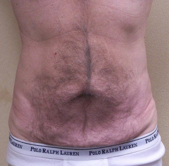 VASER Shape to Abdomen