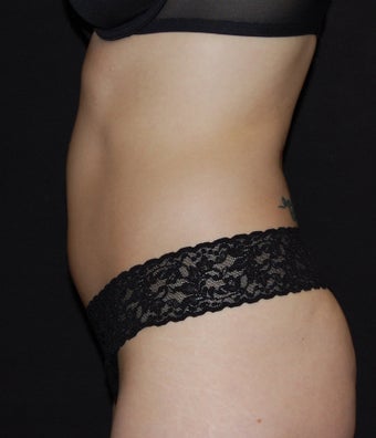 VASER Shape to Abdomen