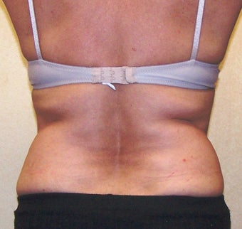 VASER Shape fo Back