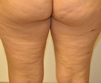 VASER Shape to Legs
