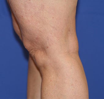 VASER Shape to Legs