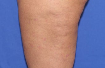 VASER Shape to Legs