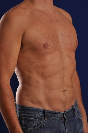 Vaser Hi Def Liposuction of the abdomen, chest, back, and flanks with fat injections to the pectoralis region