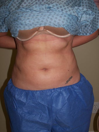 Vaser liposuction