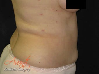 Vaser Lipo - Abdomen