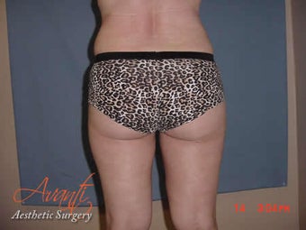 Vaser Lipo - Outer Thighs