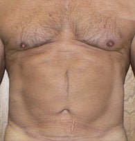 VASER liposuction of abdominal wall