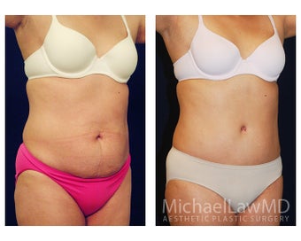 Tummy Tuck with Liposuction