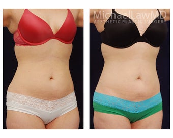 Liposuction