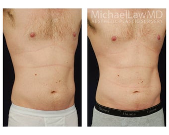 Liposuction
