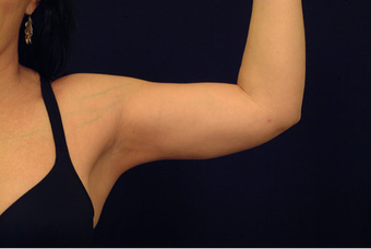 Liposuction