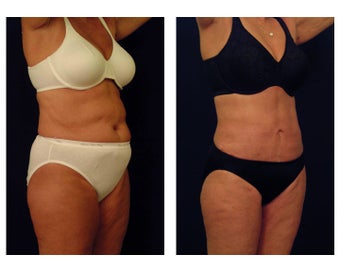 Liposuction