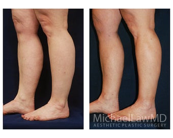 Liposuction