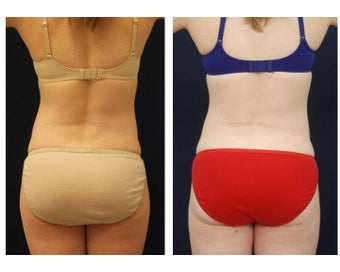 Liposuction