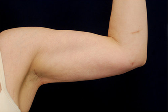 Liposuction