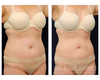 Liposuction