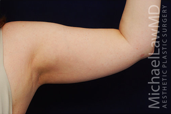 Liposuction