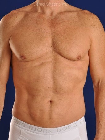 Vaser Hi Def Liposuction of chest, abdomen, back and flanks
