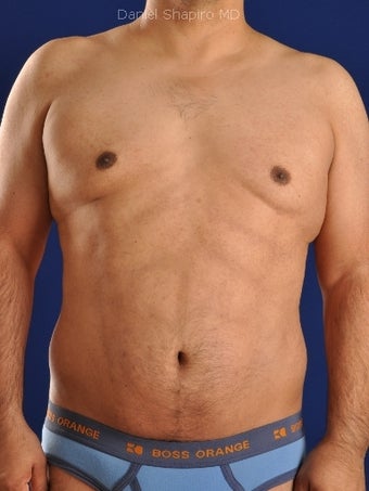 Vaser Hi-Def Liposuction of abdomen, chest, back and flanks
