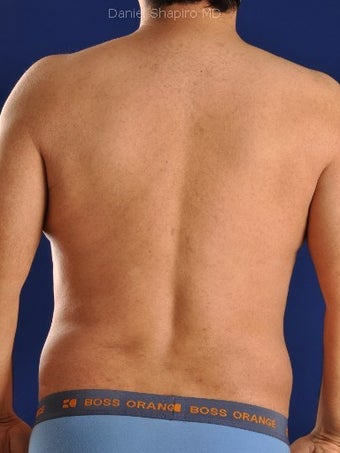 Vaser Hi Def Liposuction of chest, abdomen, back and flanks