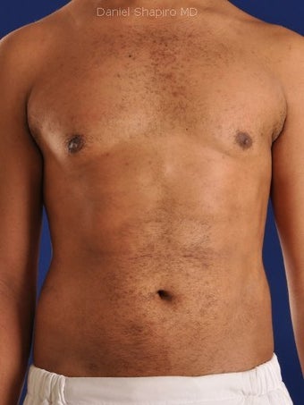 Vaser Hi Def Liposuction of the abdomen, chest, back, and flanks with fat injections to the pectoralis region